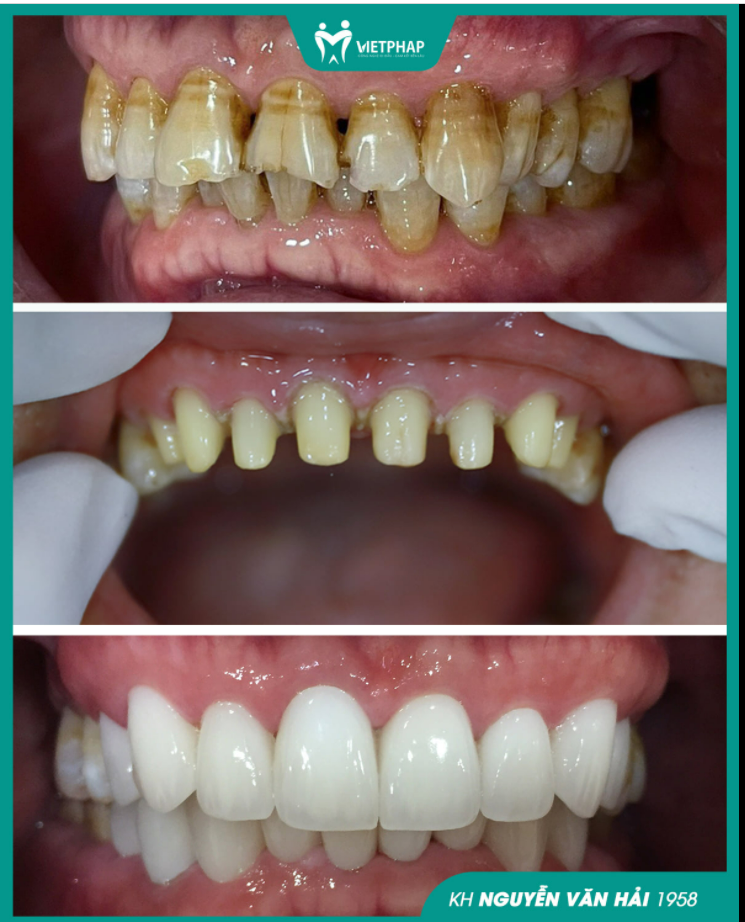 U70 LẤY LẠI PHONG ĐỘ NGÚT NGÀN SAU THẨM MỸ 16 RĂNG SỨ CERAMILL