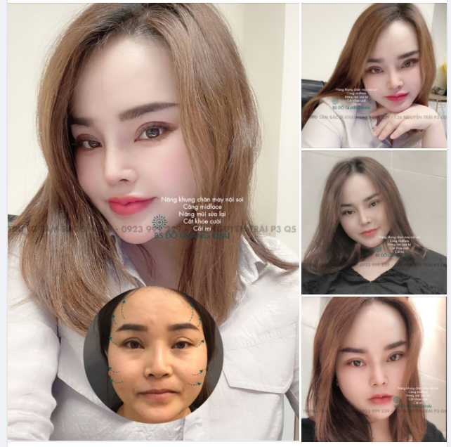 ƯU ĐIỂM 2 PP NÂNG KHUNG CHÂN MÀY VÀ CĂNG DA MẶT TẠI TRUNG TÂM BSK KHÁC BIỆT NHỮNG NƠI KHÁC
