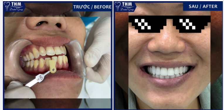 VENEER SỨ - GIẢI PHÁP THẨM MỸ RĂNG XÂM LẤN TỐI THIỂU
