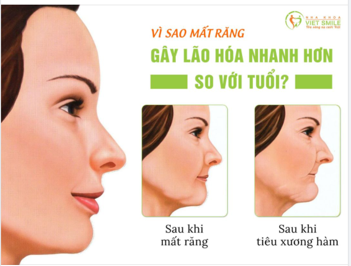 VÌ SAO MẤT RĂNG GÂY LÃO HÓA NHANH HƠN SO VỚI TUỔI? 