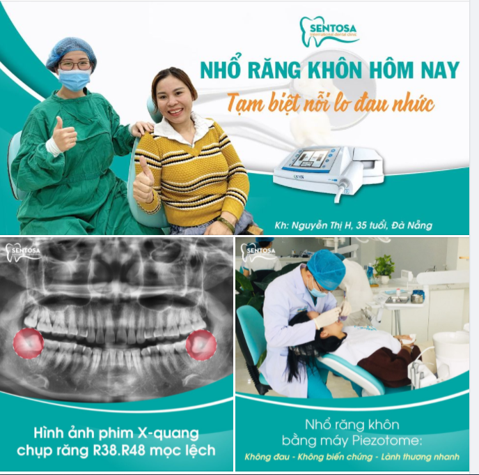 VÌ SAO NÊN NHỔ RĂNG KHÔN RĂNG 8 TẠI SENTOSA ?