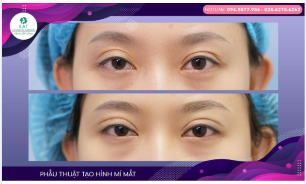Vì sao nhiều chị em mắt 2 mí vẫn tìm đến KAT để tạo hình mí mắt