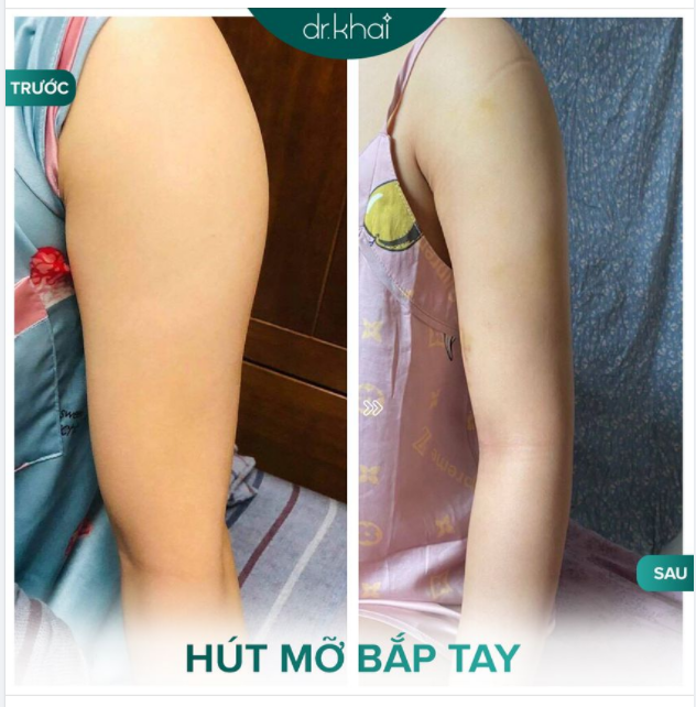 VĨNH BIỆT BẮP TAY THÔ - TO - ĐẦY MỠ