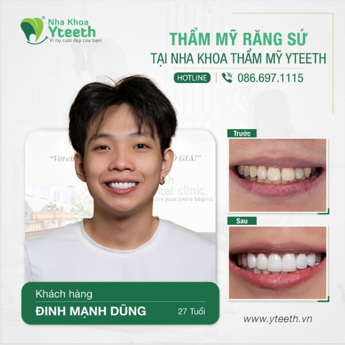 Với phương pháp phục hình răng sứ thẩm mỹ, và đây là kết quả trước và sau của anh Dũng khi làm dịch vụ.