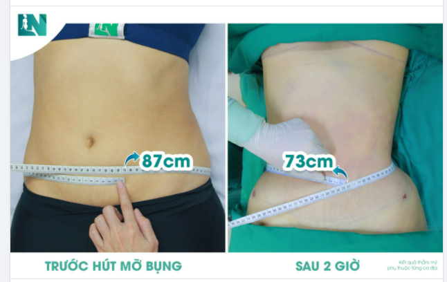 VÒNG BỤNG SAU 2 GIỜ HÚT MỠ THAY ĐỔI NHƯ THẾ NÀO
