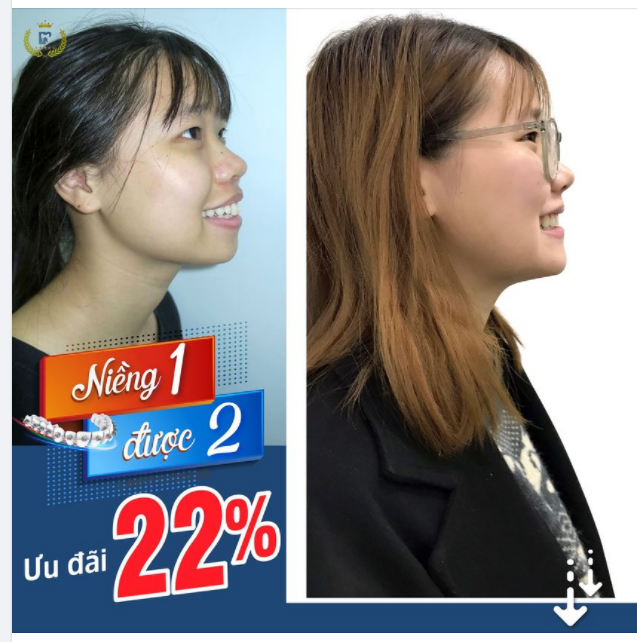 VỪA CÓ RĂNG ĐẸP, VỪA SỞ HỮU CẰM V-LINE ĐẸP TỰ NHIÊN