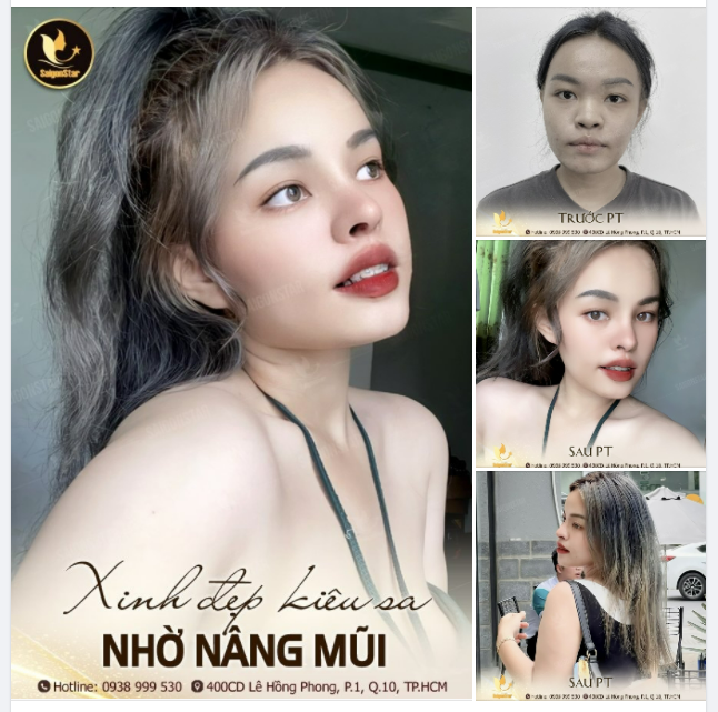 XINH ĐẸP KIÊU SA NHỜ NÂNG MŨI TẠI DR.HOẠT