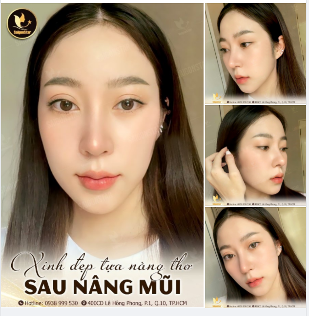 XINH ĐẸP TỰA NÀNG THƠ SAU NÂNG MŨI