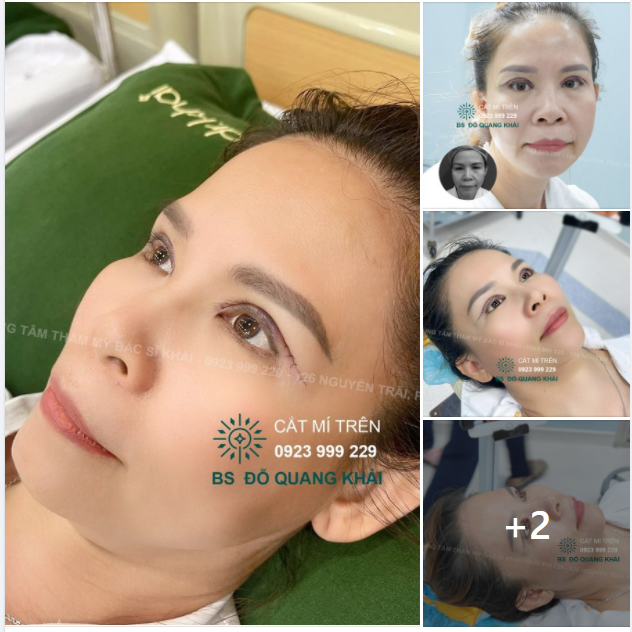 XINH ĐẸP TƯƠI TRẺ NGAY SAU CẮT MÍ