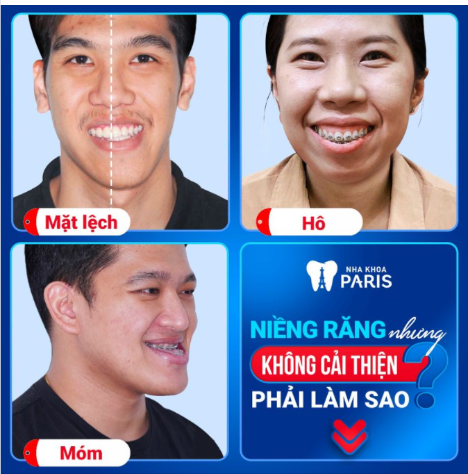 Xoá bỏ 100% hô, móm, mặt lệch, hở lợi