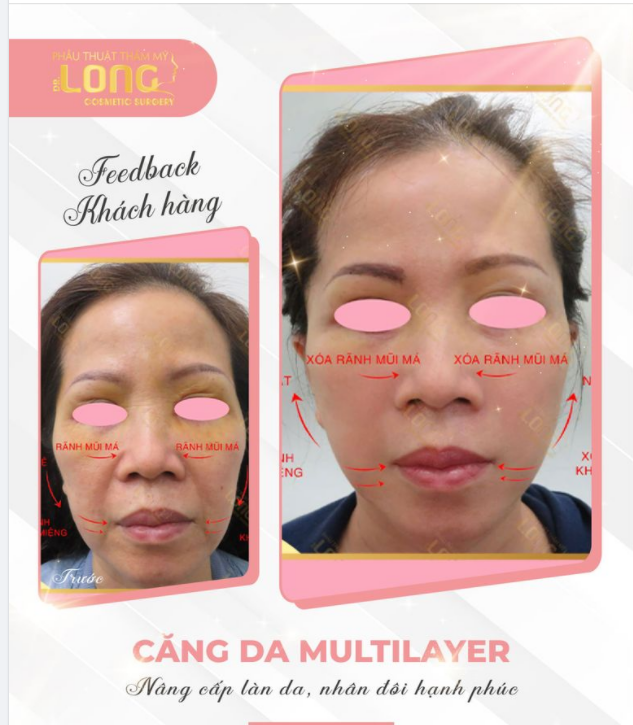 XÓA NHĂN DA CĂNG TRẺ HÓA CHỈ NGAY SAU 60 PHÚT