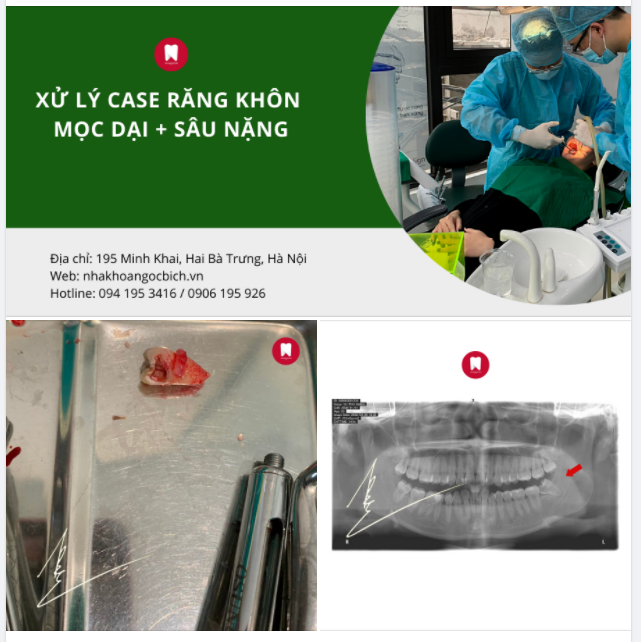 XỬ LÝ CASE RĂNG KHÔN MỌC DẠI ​​​​​​​SÂU NẶNG