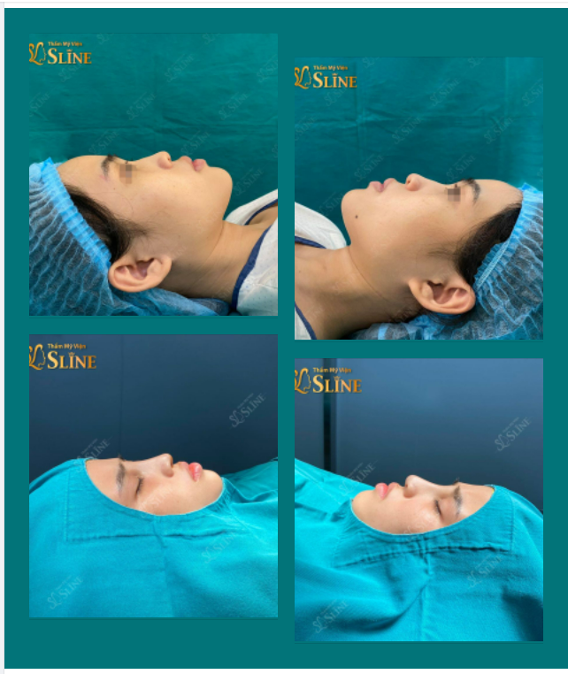 1 ca Mũi đẹp nhẹ nhàng và vô cùng tự nhiên