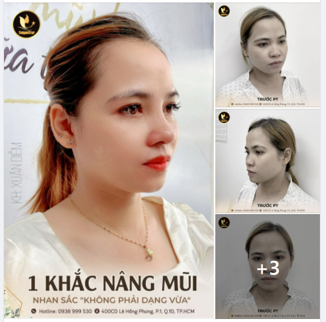 1 KHẮC NÂNG MŨI NHAN SẮC KHÔNG PHẢI DẠNG VỪA