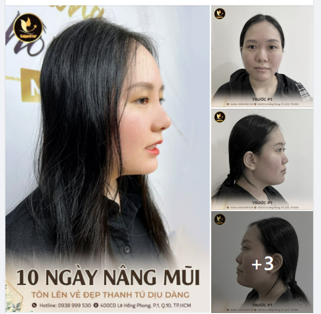 10 NGÀY NÂNG MŨI TÔN LÊN VẺ ĐẸP THANH TÚ DỊU DÀNG