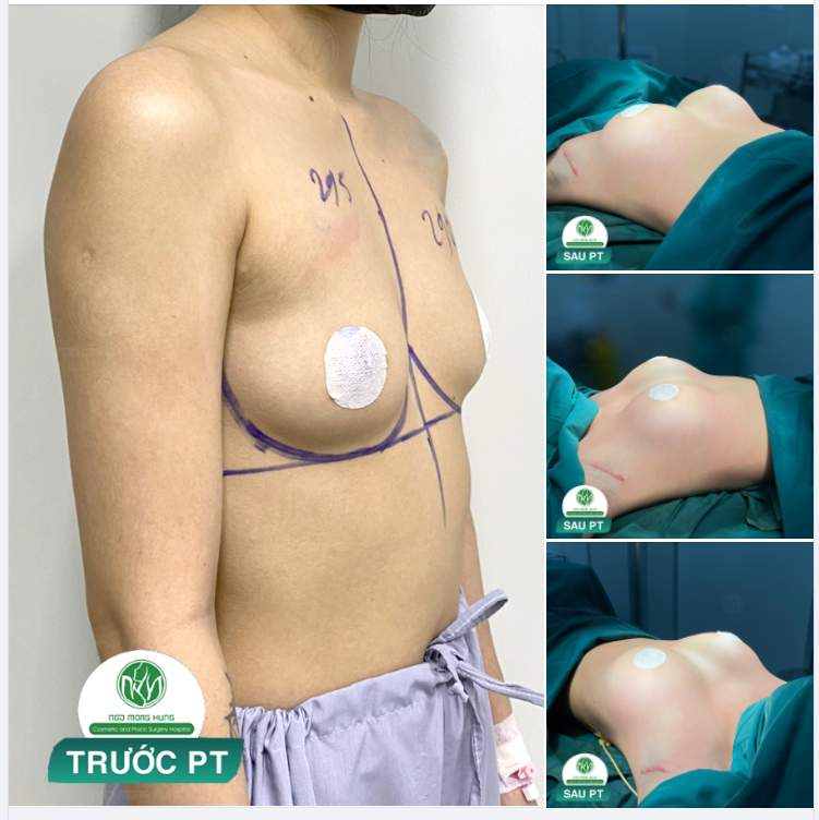 1000 độ C VỚI KẾT QUẢ SAU NÂNG NGỰC