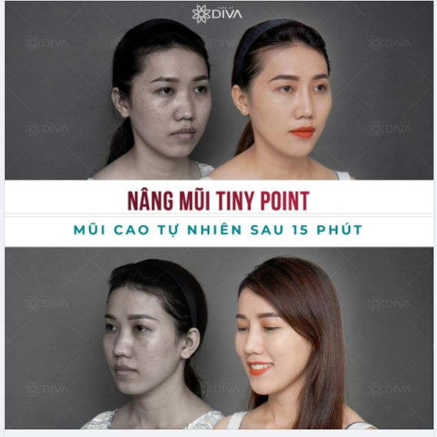15 PHÚT NÂNG MŨI TINY POINT - MŨI ĐẸP TỰ NHIÊN KHÔNG SẸO