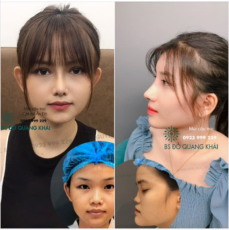 2 BẠN KHÁCH VỪA THI ĐẠI HỌC XONG ĐƯỢC BỐ MẸ ỦNG HỘ VIỆC PHẪU THUẬT THẨM MỸ