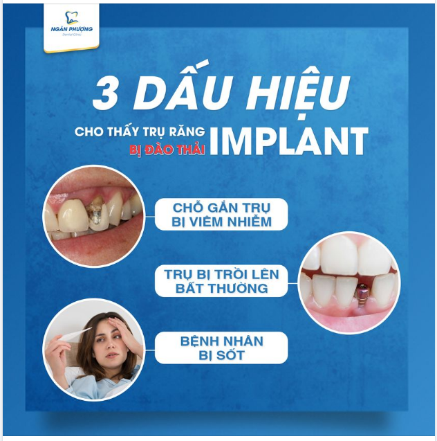 3 dấu hiệu cho thấy trụ răng Implant bị đào thải