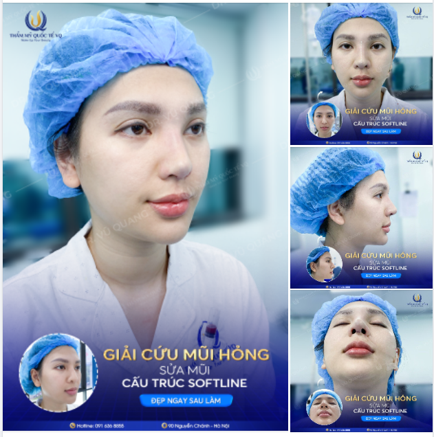 3 lần thẩm mỹ mũi đến BIẾN DẠNG - Đến Dr Vũ Quang sửa lại vẫn đẹp bất ngờ .