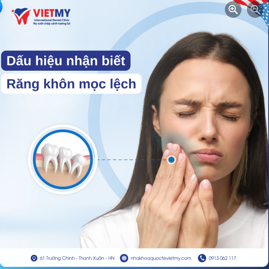 4 DẤU HIỆU NHẬN BIẾT RĂNG KHÔN MỌC LỆCH