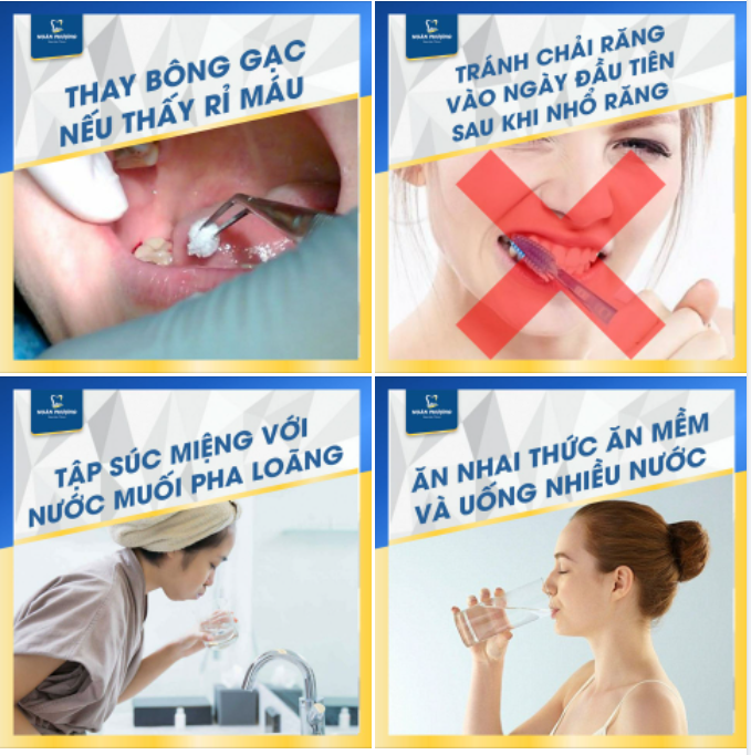4 tips vệ sinh răng miệng sau khi nhổ răng khôn