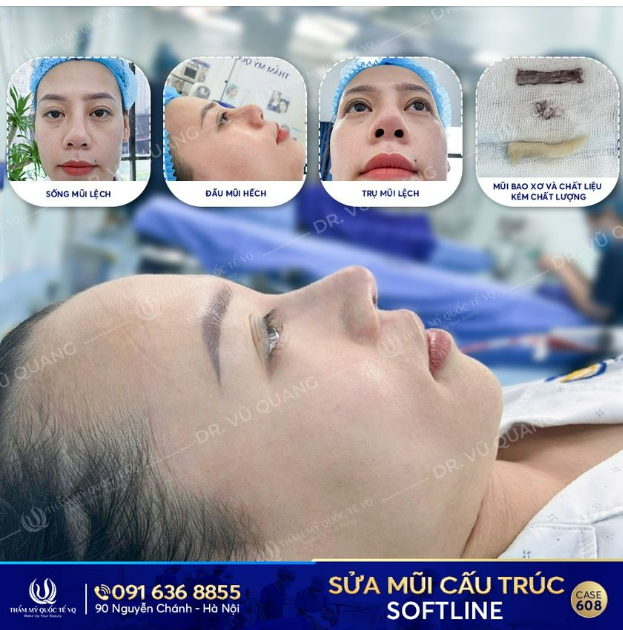 4h sáng, chị Thu Trang 1 mình đi xe khách từ Quảng Ninh đến Thẩm mỹ Quốc tế VQ, mang theo nhiều nỗi lo âu với chiếc mũi biến dạng của mình sau khi nâng mũi tại cơ sở không uy tín