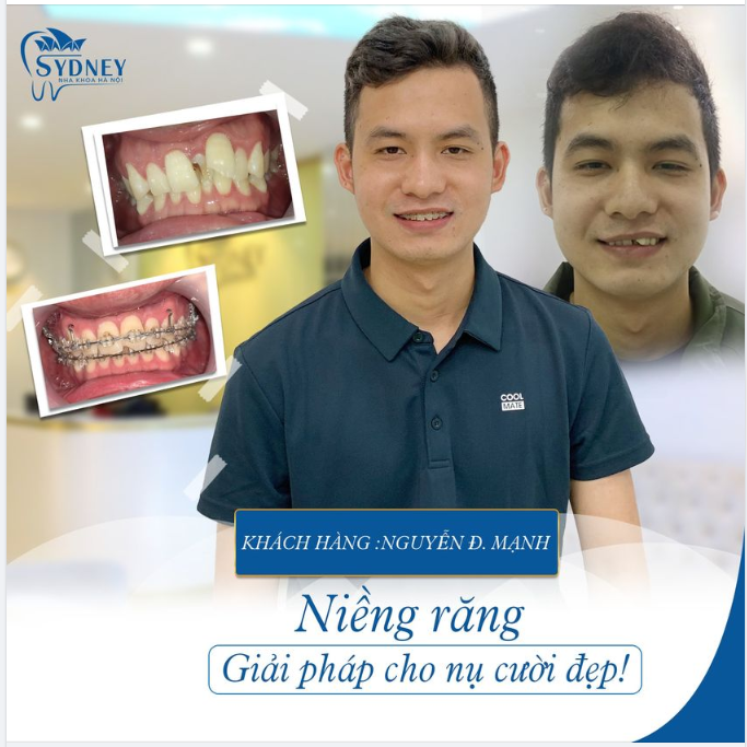 5 LÝ DO KHIẾN BẠN NIỀNG RĂNG NGAY HÔM NAY