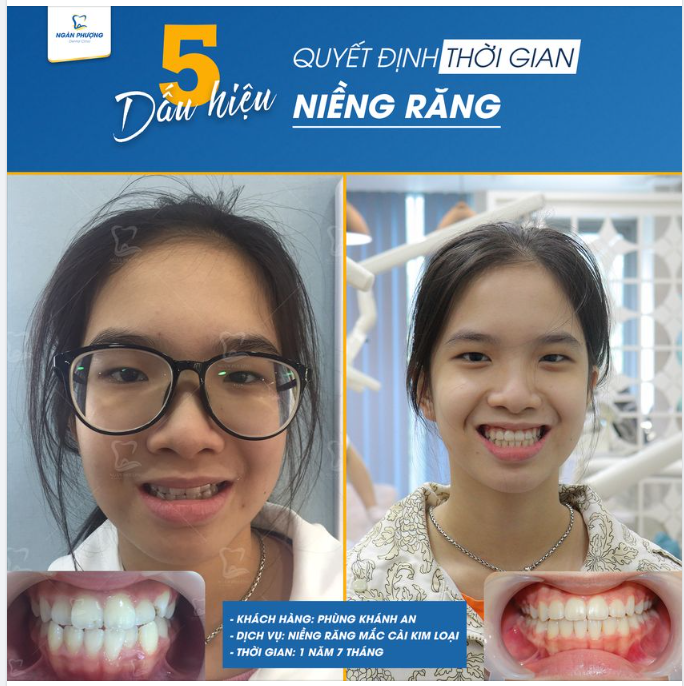 5 YẾU TỐ QUYẾT ĐỊNH THỜI GIAN NIỀNG RĂNG CỦA BẠN