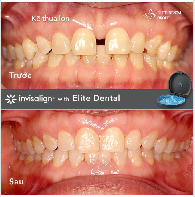 50 tuổi có niềng răng trong suốt được không -  Có hiệu quả không?