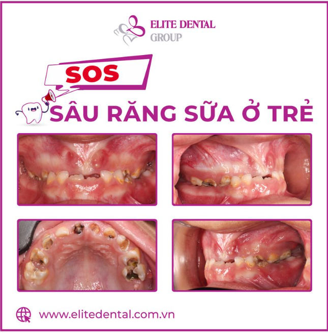 7 tuổi, sâu nặng các răng sữa có đáng lo?