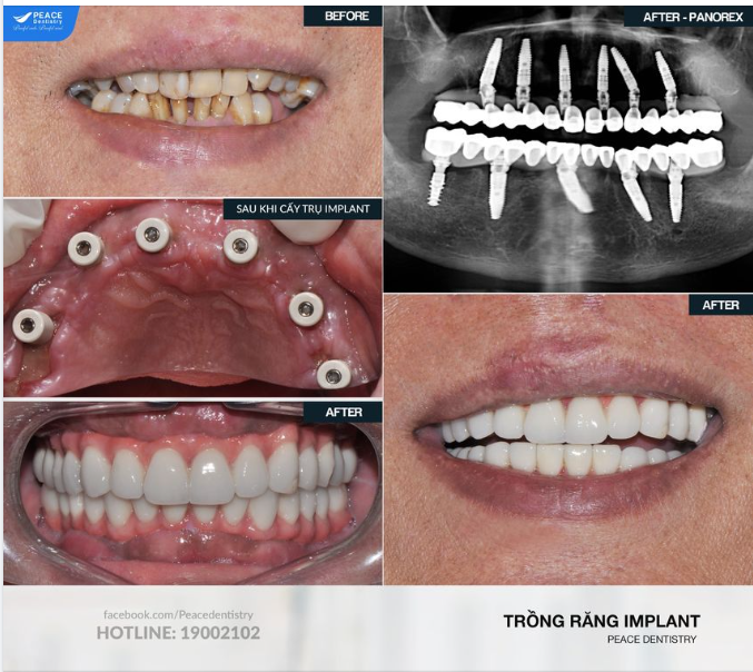 ALL-ON-6 IMPLANT CHO HÀM TRÊN, ALL-ON-5 IMPLANT CHO HÀM DƯỚI