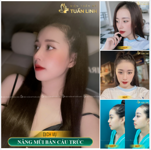 ANGEL LINE TỰ NHIÊN - Cho bạn gái thích dáng mũi nhẹ nhàng