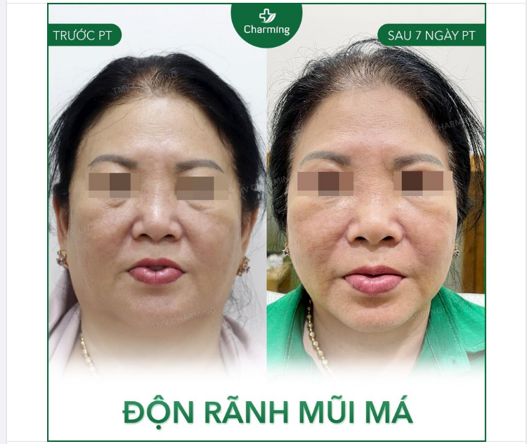 Bạn có biết rãnh mũi má sâu và lõm theo một cách bất thường có thể khiến khuôn mặt bạn có phần biến dạng ở vùng rãnh này.