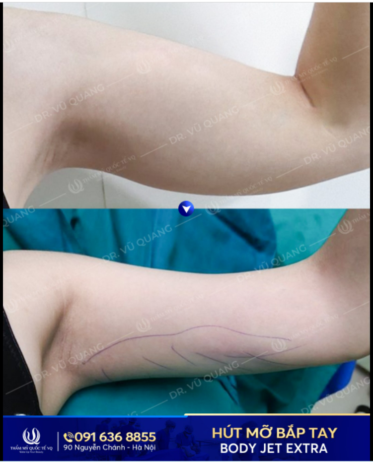 Bắp tay to như lực sĩ, ngấn mỡ khó tiêu giảm dù đã dùng nhiều phương pháp