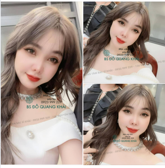 BẤT NGỜ NHAN SẮC ĐÔI MƯƠI SAU 5 LẦN CHỈNH SỬA MŨI
