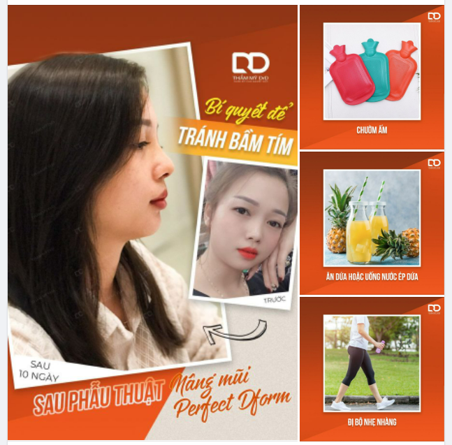 Bí quyết để tránh bầm tím sau phẫu thuật Nâng mũi Perfect Dform