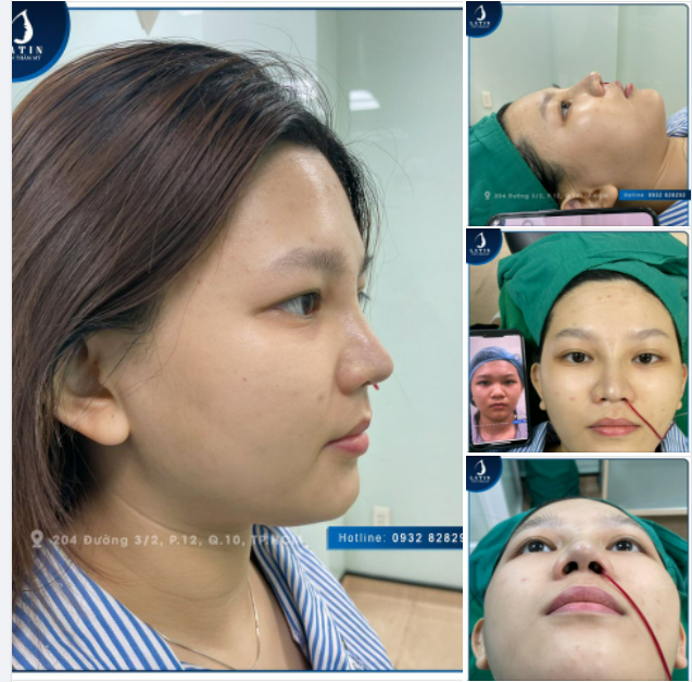 Biến hình ngoạn mục cùng Latin Mũi bán cấu trúc, thu nền mũi