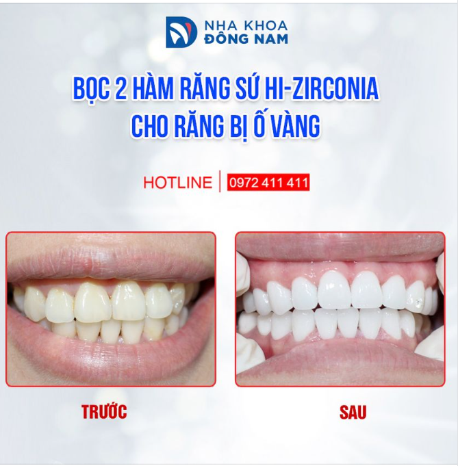 BỌC RĂNG SỨ - KĨ THUẬT ĐÒI HỎI BÁC SĨ TRÌNH ĐỘ CHUYÊN MÔN VỮNG VÀNG, KINH NGHIỆM DÀY DẶN VÀ GU THẨM MỸ TINH TẾ