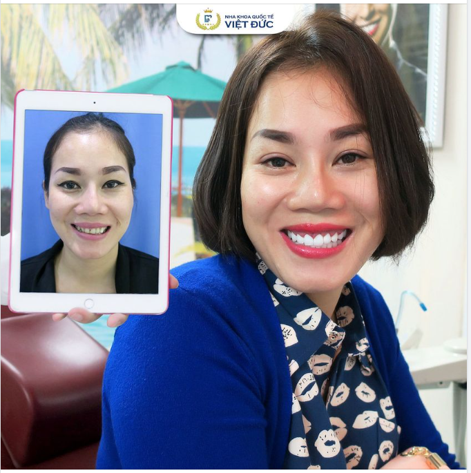 BỌC RĂNG SỨ NANO CERAMIC - ĐẸP NGAY SAU KHI BỌC