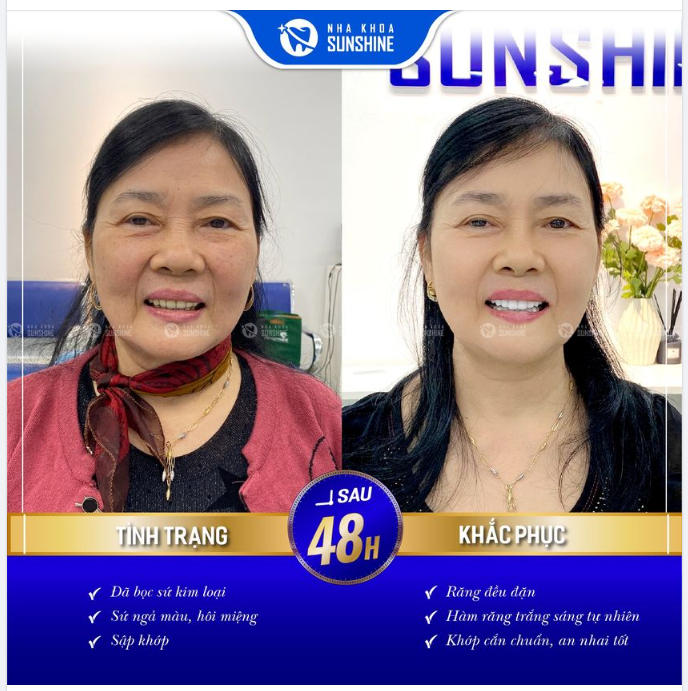 BỌC RĂNG SỨ - ƯU ĐÃI KHỦNG 80%