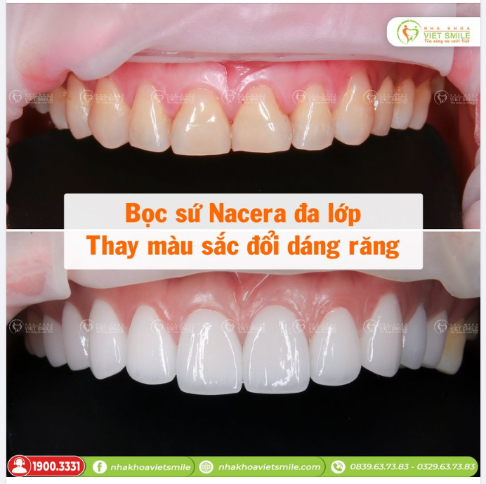 BỌC SỨ NACERA ĐA LỚP - THAY MÀU SẮC ĐỔI DÁNG RĂNG