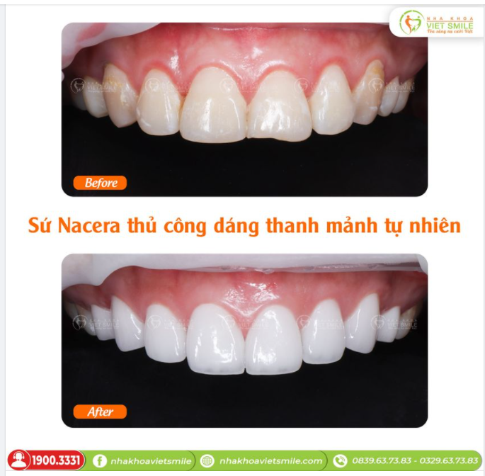 BỌC SỨ NACERA THỦ CÔNG DÁNG THANH MẢNH TỰ NHIÊN
