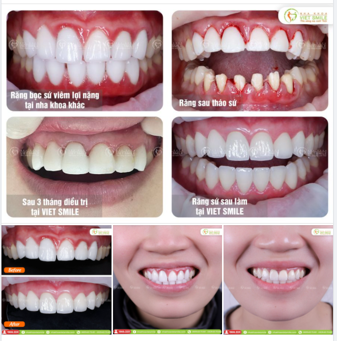 BỌC SỨ THẨM MỸ 12 RĂNG - GIẢI CỨU RĂNG SỨ HỎNG GÂY VIÊM LỢI CẤP