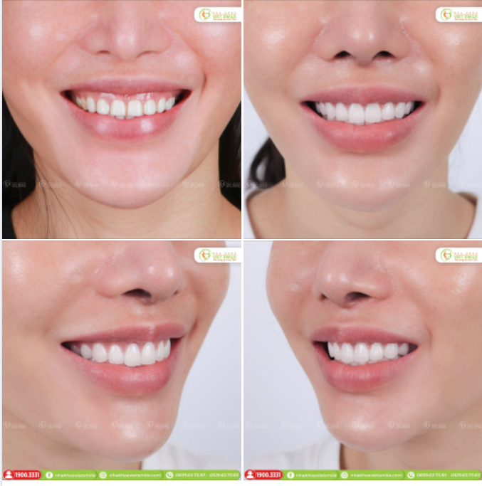 BỌC SỨ THẨM MỸ 20 RĂNG TRẮNG TRONG TỰ NHIÊN