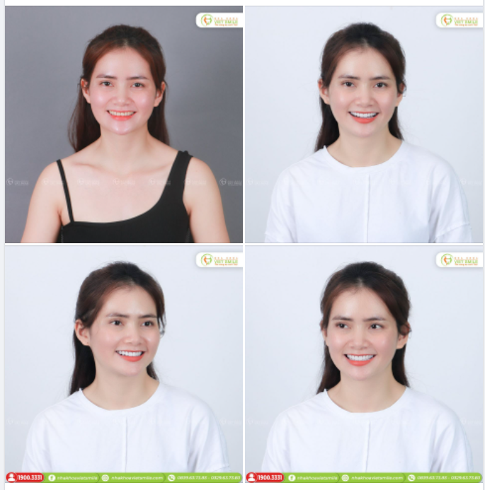 BỌC SỨ THẨM MỸ - RĂNG ĐẸP HƠN, NỤ CƯỜI RẠNG RỠ HƠN