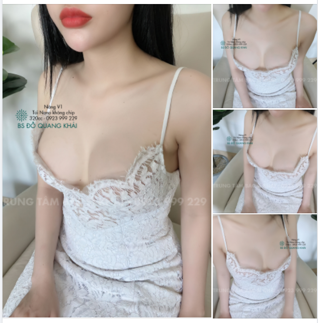 BỎNG MẮT với KẾT QUẢ 25 NGÀY NÂNG V1 SIZE 320CC