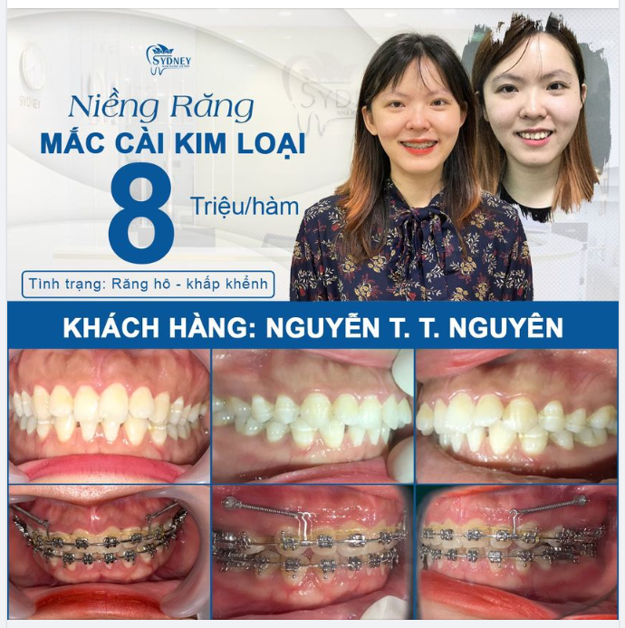 BƯỚC ĐẦU LÀM MỚI BẢN THÂN - THAY ĐỔI NỤ CƯỜI CỦA BẠN