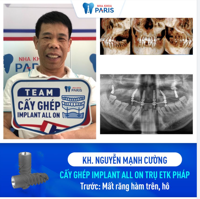 Ca cấy ghép Implant All On 6 - Trụ Implant ETK Pháp độc quyền tại Nha khoa Paris chi nhánh Hải Phòng!
