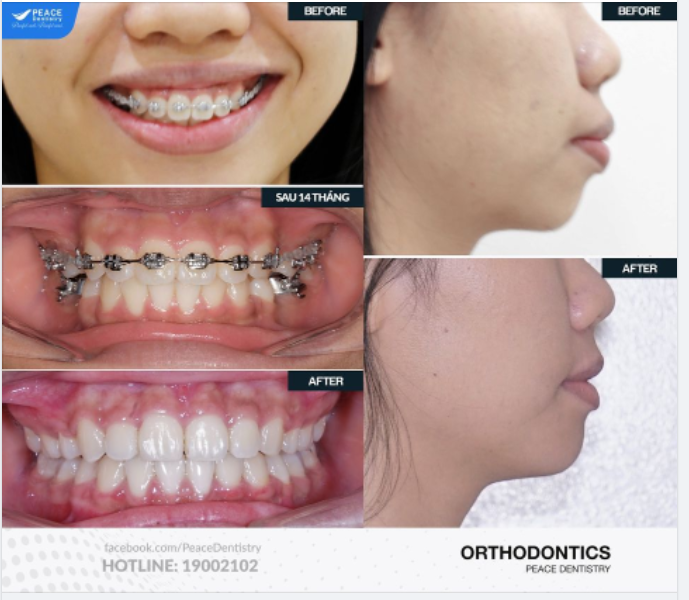Ca lâm sàng niềng răng chỉnh hô và giải đáp câu hỏi: Niềng răng hô thì khuôn mặt thay đổi như thế nào?